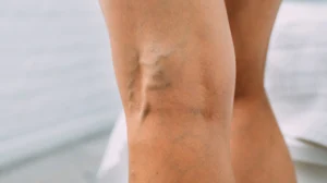 Pregnancy and Varicose Veins: What Expecting Mothers Need to Know