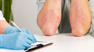 Why Psoriasis Awareness Month Matters